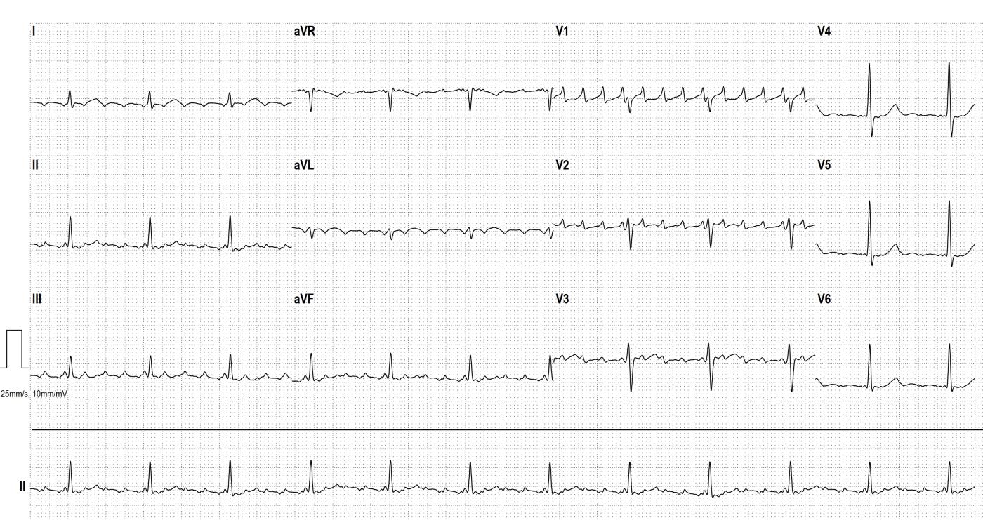 atypical-atrial-flutter-from-the-left-atrium-ecg-guru-instructor